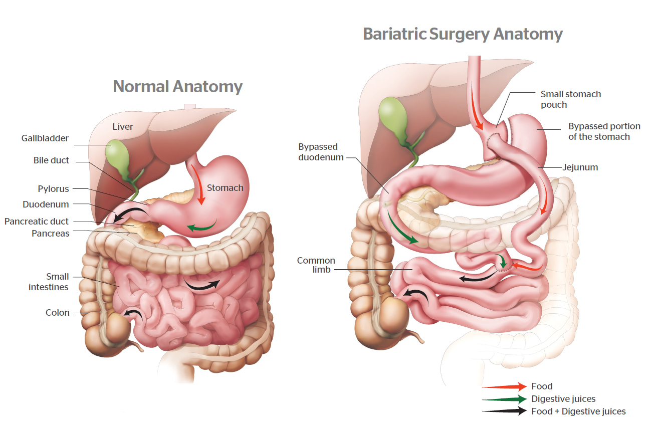 Gastric Bypass Surgery - Macquarie Weight Loss and Surgical Services